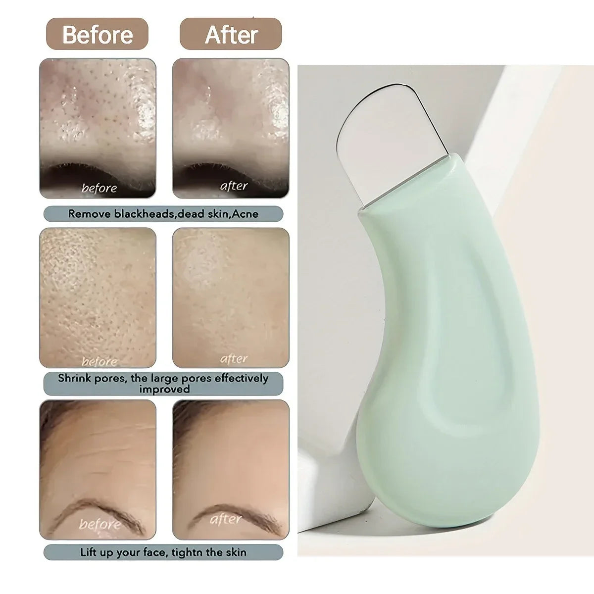 Blackhead & Whitehead Remover Tool for Nose and Face